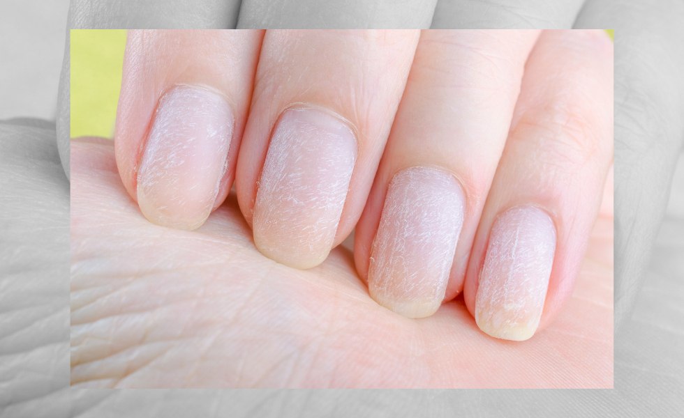 Unhealthy Nails Signs - Nail Biting