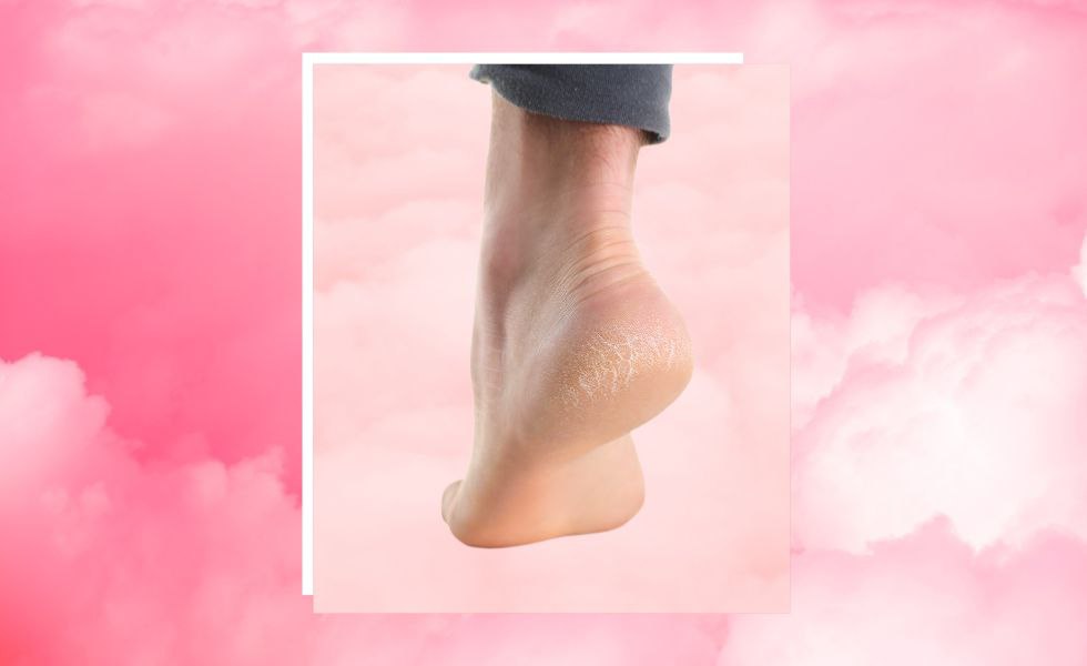 Cracked Heels Myths and Facts